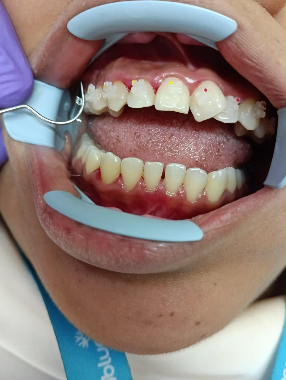 Colocación profesional de brackets